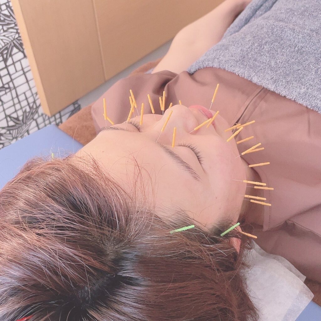 美容鍼